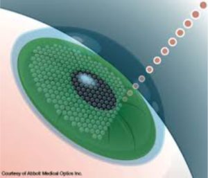 Lasik in Pune