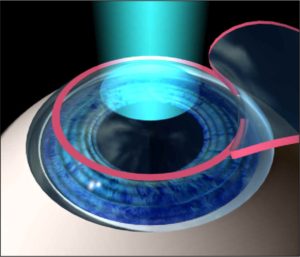 lasik surgery in pune